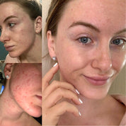 Acne Rehab Serum 30ml